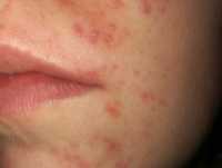 perioral dermatitis DermNet NZ image